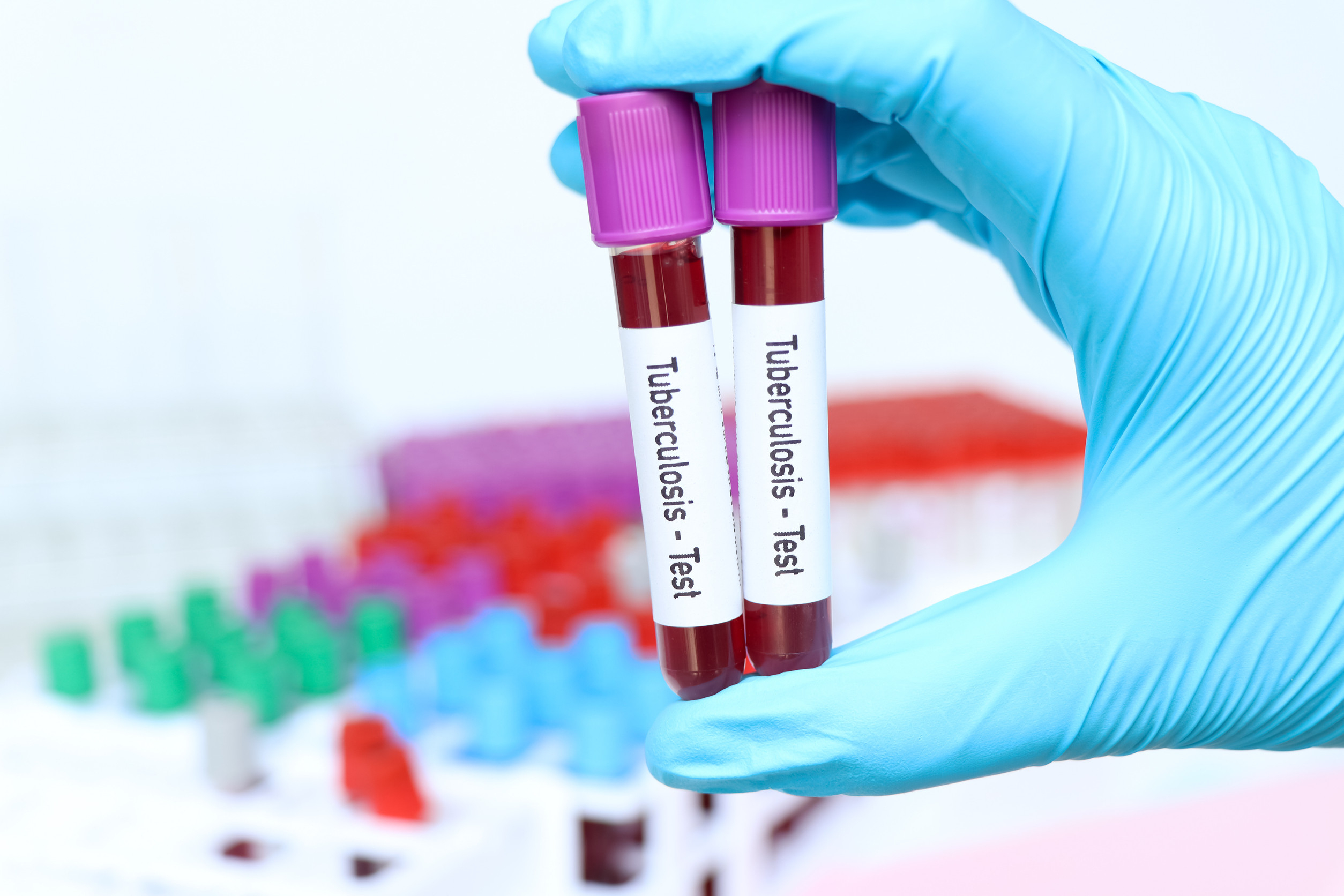 Understanding The Uk Visa Tb Test Requirements